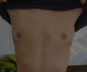 pectus excavatum cirugia excavatum