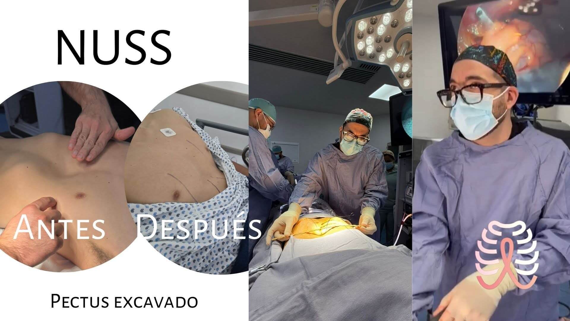 Pectus excavado NUSS